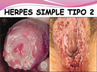 HERPES SIMPLE TIPO 2
 