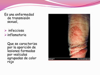 Es una enfermedad
  de transmisión
  sexual,

 infecciosa
 inflamatoria

 Que se caracteriza
 por la aparición de
 lesiones formadas
 por vesículas
 agrupadas de color
 rojo
 