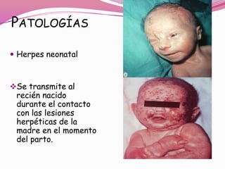 PATOLOGÍAS

 Herpes neonatal



Se transmite al
 recién nacido
 durante el contacto
 con las lesiones
 herpéticas de la
 madre en el momento
 del parto.
 
