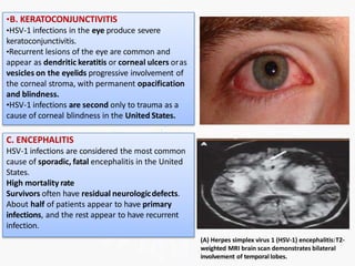•B. KERATOCONJUNCTIVITIS
•HSV-1 infections in the eye produce severe
keratoconjunctivitis.
•Recurrent lesions of the eye are common and
appear as dendritic keratitis or corneal ulcers oras
vesicles on the eyelids progressive involvement of
the corneal stroma, with permanent opacification
and blindness.
•HSV-1 infections are second only to trauma as a
cause of corneal blindness in the United States.
C. ENCEPHALITIS
HSV-1 infections are considered the most common
cause of sporadic, fatal encephalitis in the United
States.
High mortality rate
Survivors often have residual neurologicdefects.
About half of patients appear to have primary
infections, and the rest appear to have recurrent
infection.
(A) Herpes simplex virus 1 (HSV-1) encephalitis:T2-
weighted MRI brain scan demonstrates bilateral
involvement of temporal lobes.
 