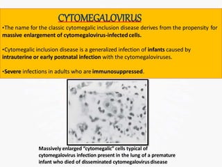 CYTOMEGALOVIRUS
•The name for the classic cytomegalic inclusion disease derives from the propensity for
massive enlargement of cytomegalovirus-infectedcells.
•Cytomegalic inclusion disease is a generalized infection of infants caused by
intrauterine or early postnatal infection with the cytomegaloviruses.
•Severe infections in adults who are immunosuppressed.
Massively enlarged “cytomegalic” cells typical of
cytomegalovirus infection present in the lung of a premature
infant who died of disseminated cytomegalovirusdisease
 