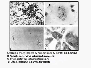 Cytopathic effects induced by herpesviruses. A: Herpes simplexvirus
B: Varicella-zoster virus in human kidneycells
C: Cytomegalovirus in human fibroblasts
D: Cytomegalovirus in human fibroblasts
 