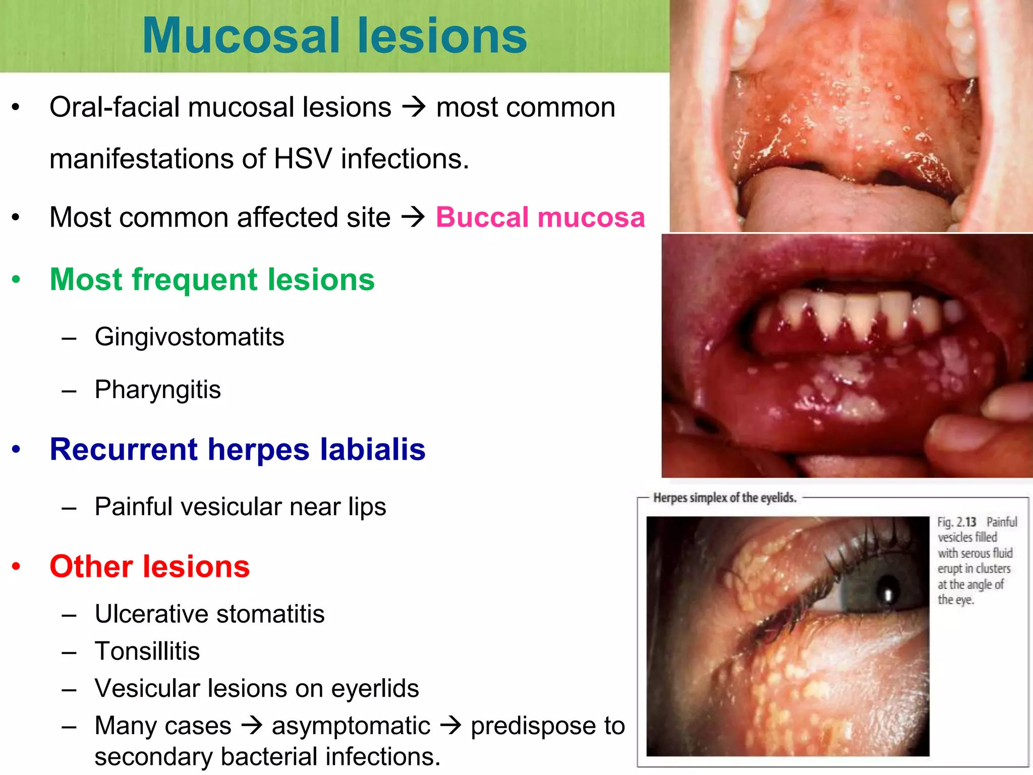 Mucosal lesions
• Oral-facial mucosal lesions  most common
manifestations of HSV infections.
• Most common affected site  Buccal mucosa
• Most frequent lesions
– Gingivostomatits
– Pharyngitis
• Recurrent herpes labialis
– Painful vesicular near lips
• Other lesions
– Ulcerative stomatitis
– Tonsillitis
– Vesicular lesions on eyerlids
– Many cases  asymptomatic  predispose to
secondary bacterial infections.
 