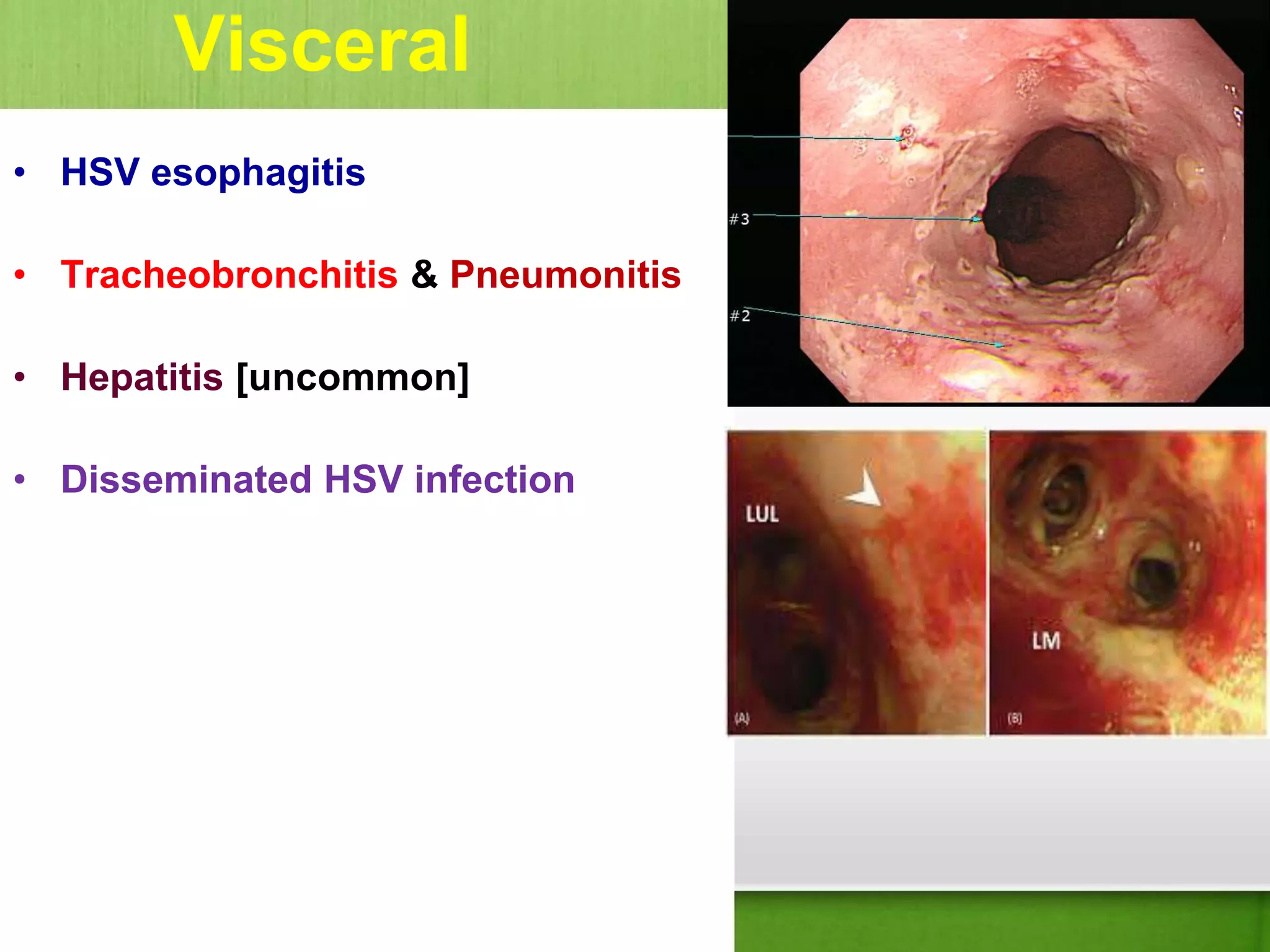 Visceral
• HSV esophagitis
• Tracheobronchitis & Pneumonitis
• Hepatitis [uncommon]
• Disseminated HSV infection
 