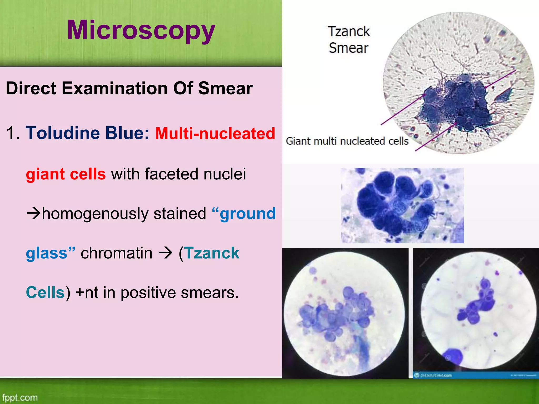 Microscopy
Direct Examination Of Smear
1. Toludine Blue: Multi-nucleated
giant cells with faceted nuclei
homogenously stained “ground
glass” chromatin  (Tzanck
Cells) +nt in positive smears.
 
