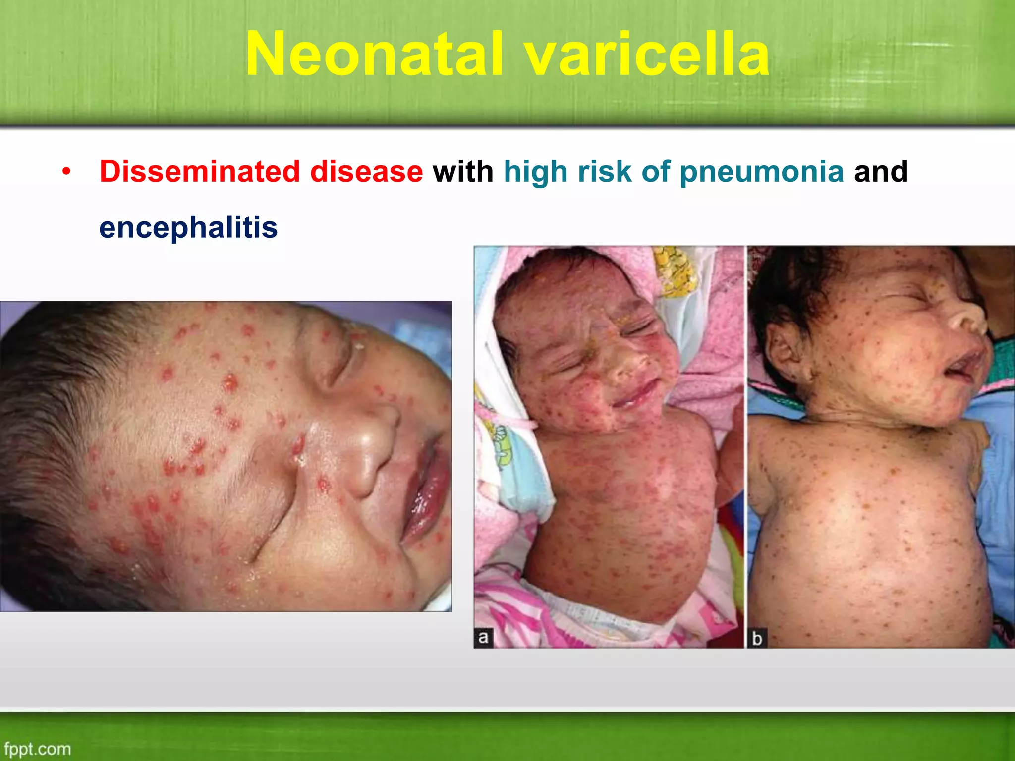 Neonatal varicella
• Disseminated disease with high risk of pneumonia and
encephalitis
 