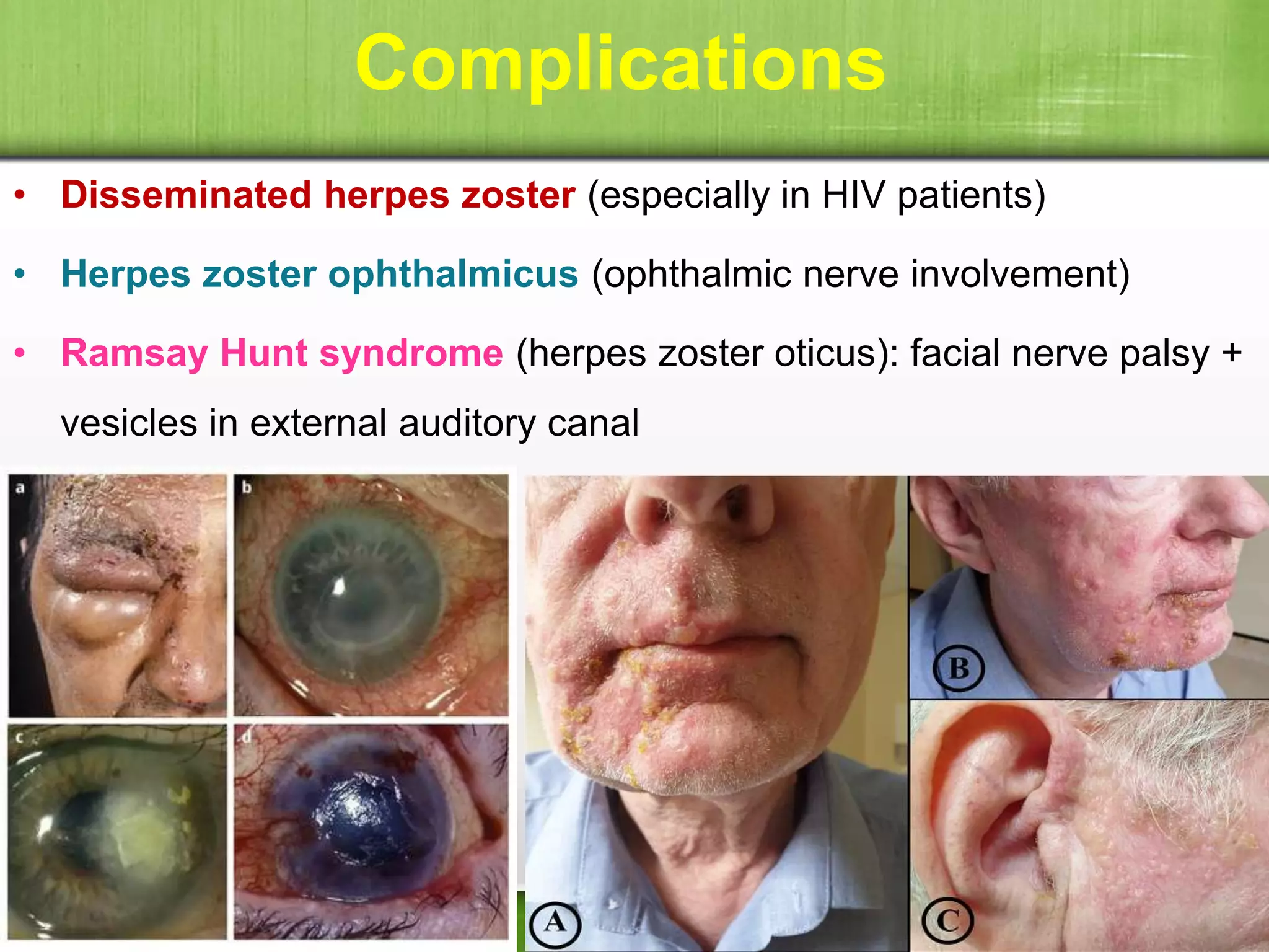 Complications
• Disseminated herpes zoster (especially in HIV patients)
• Herpes zoster ophthalmicus (ophthalmic nerve involvement)
• Ramsay Hunt syndrome (herpes zoster oticus): facial nerve palsy +
vesicles in external auditory canal
 