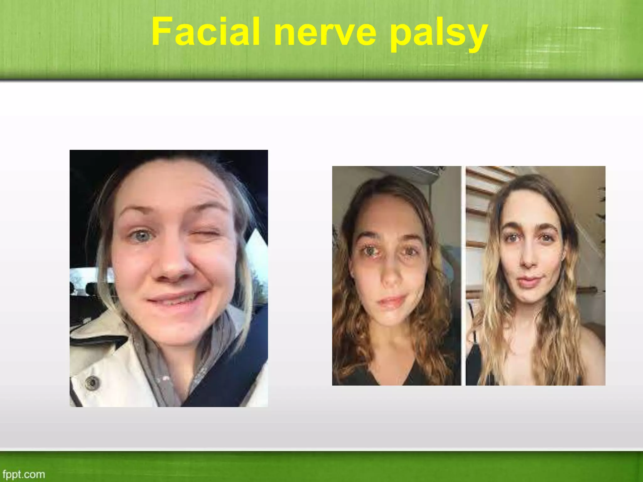 Facial nerve palsy
 
