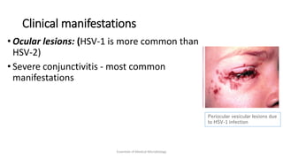 Clinical manifestations
• Ocular lesions: (HSV-1 is more common than
HSV-2)
• Severe conjunctivitis - most common
manifestations
Essentials of Medical Microbiology
Periocular vesicular lesions due
to HSV-1 infection
 