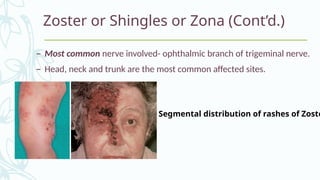 Scarf Distribution Rash herpes viruses.pptx for medical students | PPTX