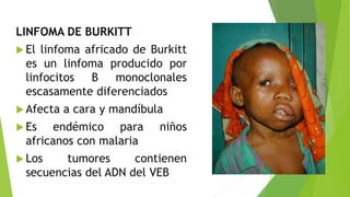 LINFOMA DE BURKITT
 El linfoma africado de Burkitt
es un linfoma producido por
linfocitos B monoclonales
escasamente diferenciados
 Afecta a cara y mandíbula
 Es endémico para niños
africanos con malaria
 Los tumores contienen
secuencias del ADN del VEB
 