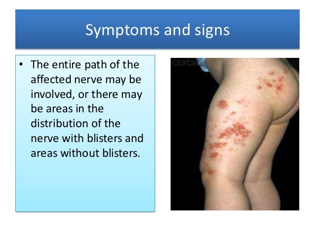 herpes zoster by dr bashir ahmed dar associate professor medicine sop