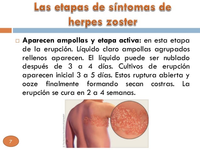 HERPES ZOSTER