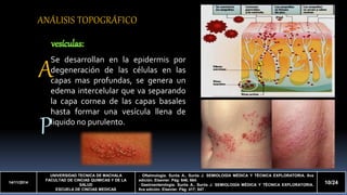 A 
P 
14/11/2014 
UNIVERSIDAD TECNICA DE MACHALA 
FACULTAD DE CINCIAS QUIMICAS Y DE LA 
SALUD 
ESCUELA DE CINCIAS MEDICAS 
- Oftalmología. Surós A., Surós J. SEMIOLOGÍA MÉDICA Y TÉCNICA EXPLORATORIA. 8va 
edición. Elsevier. Pág: 646; 664. 
- Gastroenterología. Surós A., Surós J. SEMIOLOGÍA MÉDICA Y TÉCNICA EXPLORATORIA. 
8va edición. Elsevier. Pág: 417; 847 
10/24 
ANÁLISIS TOPOGRÁFICO 
Se desarrollan en la epidermis por 
degeneración de las células en las 
capas mas profundas, se genera un 
edema intercelular que va separando 
la capa cornea de las capas basales 
hasta formar una vesícula llena de 
liquido no purulento. 
 
