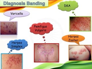 Varicella
DKA
Herpes
Zoster
Herpes
Simplex
Pemfigus
Vulgaris
 