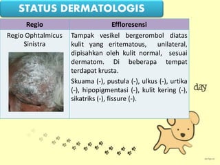 Regio Effloresensi
Regio Ophtalmicus
Sinistra
Tampak vesikel bergerombol diatas
kulit yang eritematous, unilateral,
dipisahkan oleh kulit normal, sesuai
dermatom. Di beberapa tempat
terdapat krusta.
Skuama (-), pustula (-), ulkus (-), urtika
(-), hipopigmentasi (-), kulit kering (-),
sikatriks (-), fissure (-).
STATUS DERMATOLOGIS
 