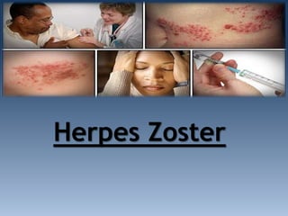 Herpes Zoster
 