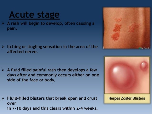 stages test 4 eye Herpes zoster stages test 4 eye Herpes zoster