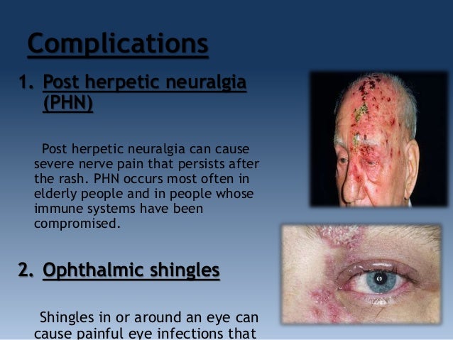 gabapentin bei herpes zoster