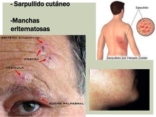 - Sarpullido cutáneo

-Manchas
eritematosas
 