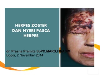 HERPES ZOSTER 
DAN NYERI PASCA HERPES 
dr. Prasna Pramita,SpPD,MARS,FINASIM 
Bogor, 2 November 2014  