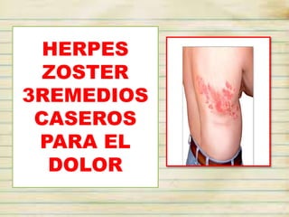 HERPES
ZOSTER
3REMEDIOS
CASEROS
PARA EL
DOLOR
 