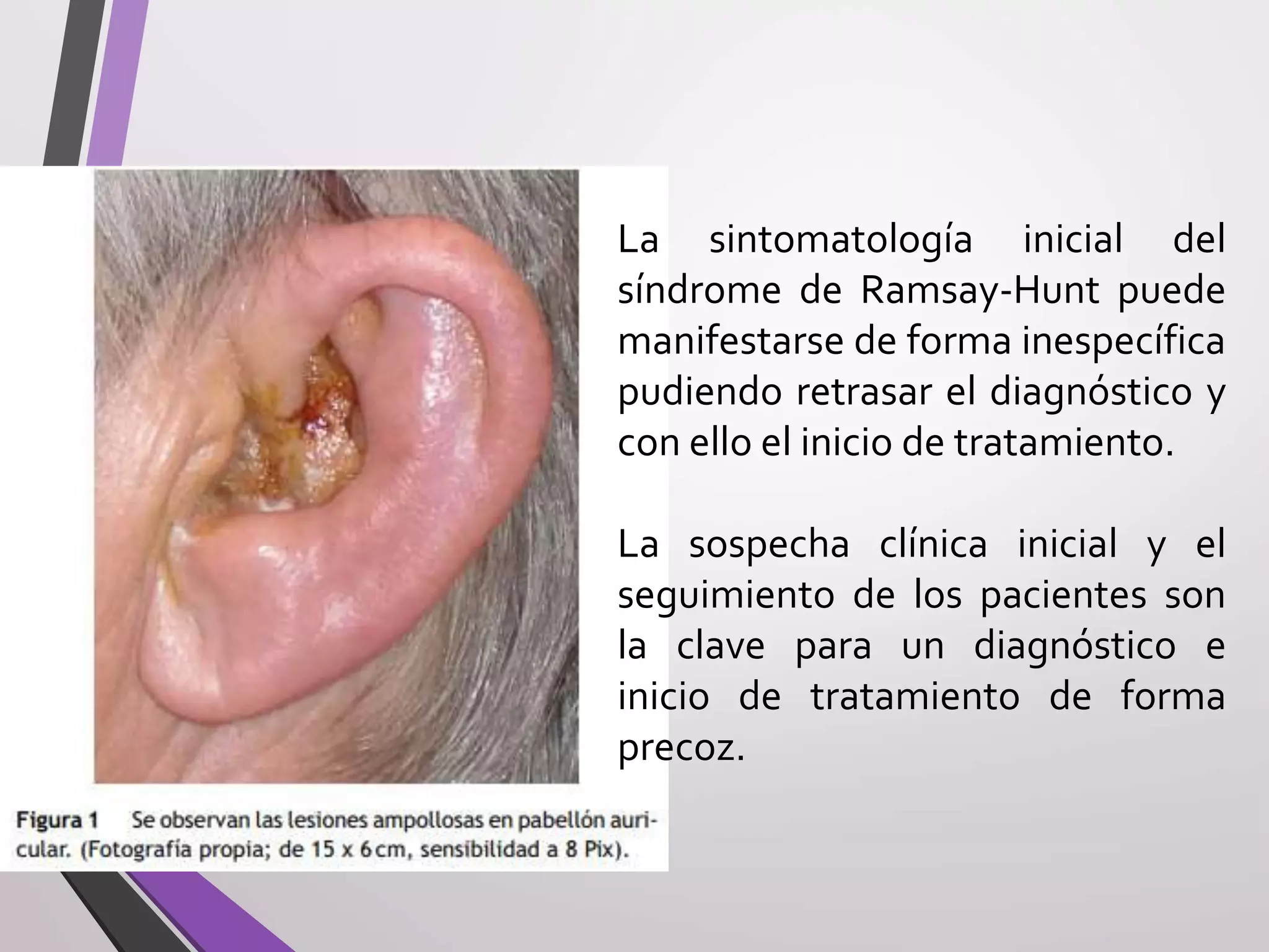 Herpes zoster y sindrome de ramsay hunt | PPTX