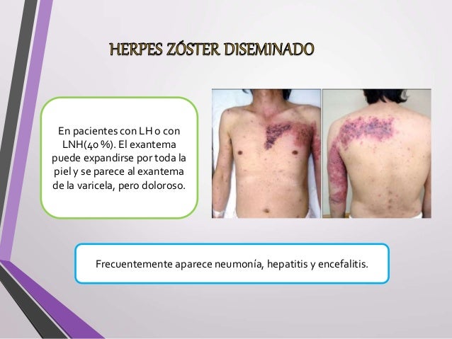 Herpes zoster y sindrome de ramsay hunt