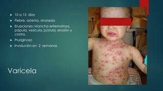 Varicela
 10 a 15 días
 Fiebre, astenia, anorexia
 Erupciones: Mancha eritematosa,
pápula, vesícula, pústula, erosión y
costra.
 Pruriginoso
 Involución en 2 semanas
 