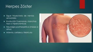 Herpes Zóster
 Sigue trayectoria de nervios
sensoriales
 Involución 3 semanas, manchas
hipo o hipercrómicas
 Neuralgia postherpética (meses a
años)
 Astenia, cefalea y febrícula
 