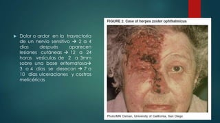  Dolor o ardor en la trayectoria
de un nervio sensitivo  2 a 4
días después aparecen
lesiones cutáneas  12 a 24
horas vesículas de 2 a 3mm
sobre una base eritematosa
3 a 4 días se desecan  7 a
10 días ulceraciones y costras
melicéricas
 