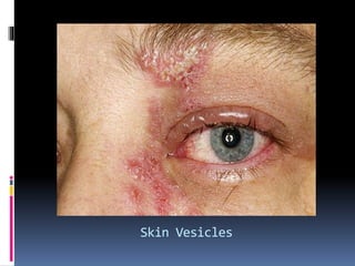 herpes simplex ocular diseases | PPTX