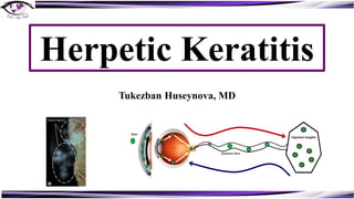 Herpetic Keratitis
Tukezban Huseynova, MD
 
