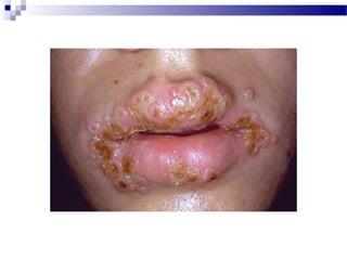 Herpetic skin infections