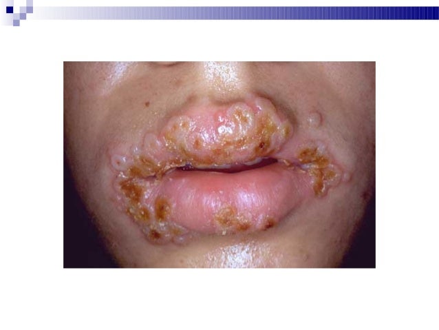 herpetic skin infections