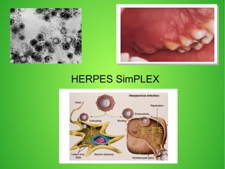 HERPES SimPLEX
 