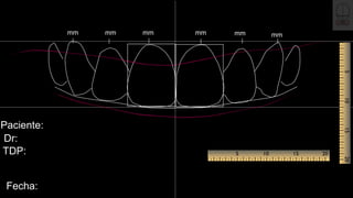 TDP:
Dr:
Fecha:
Paciente:
mm mm mm mm mm mm
 