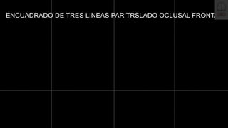 ENCUADRADO DE TRES LINEAS PAR TRSLADO OCLUSAL FRONTAL
 