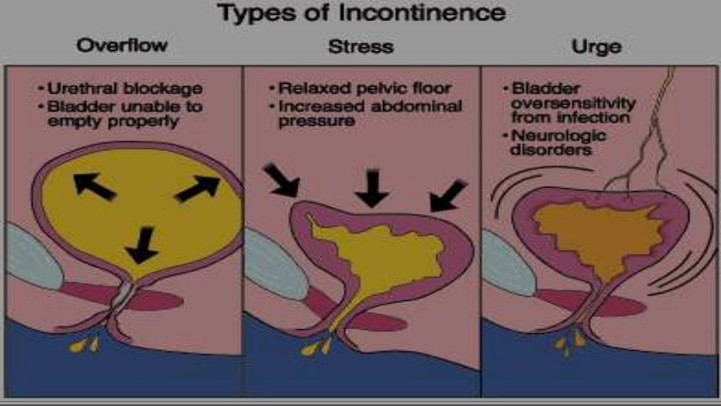 Urinary incontinence