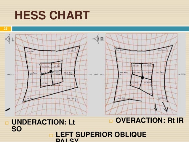 Hess Chart Interpretation