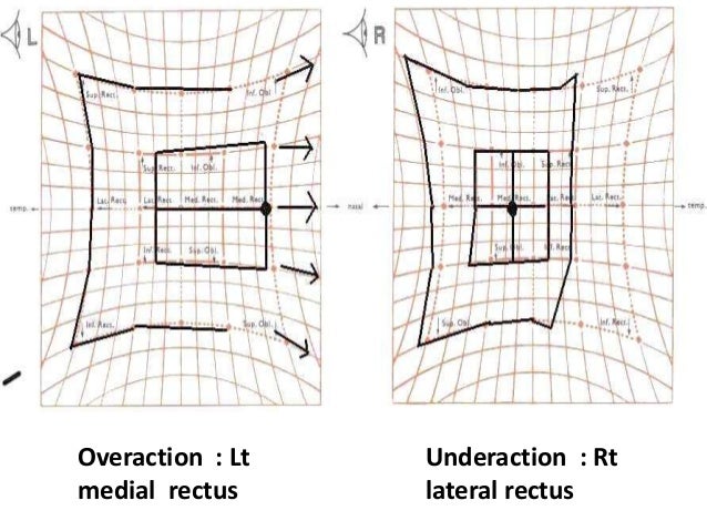 Hess Chart Interpretation