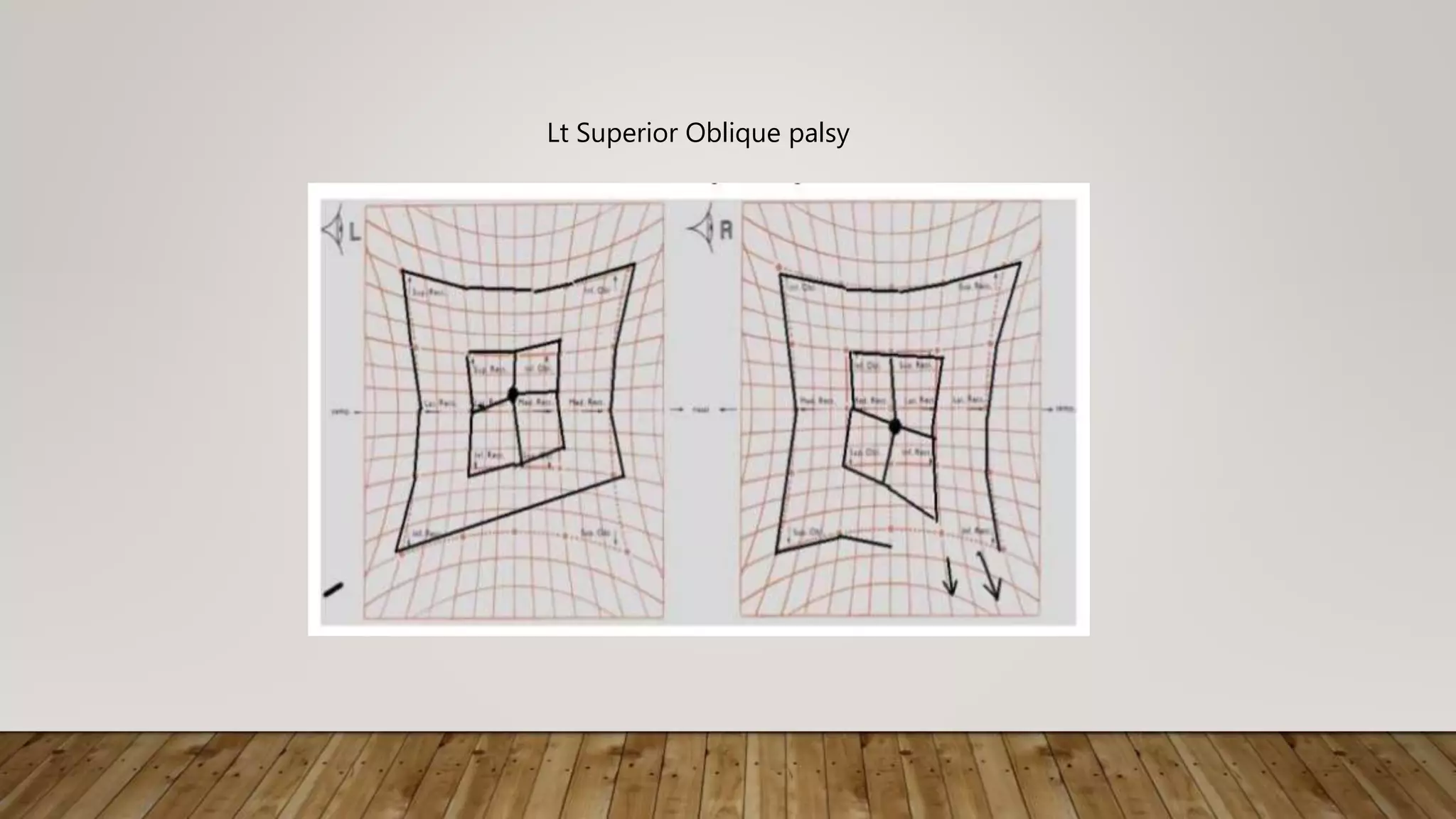 Lt Superior Oblique palsy
 