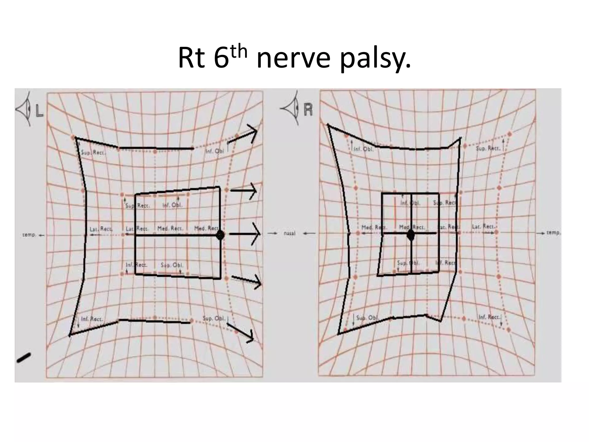 Rt 6th nerve palsy.
 