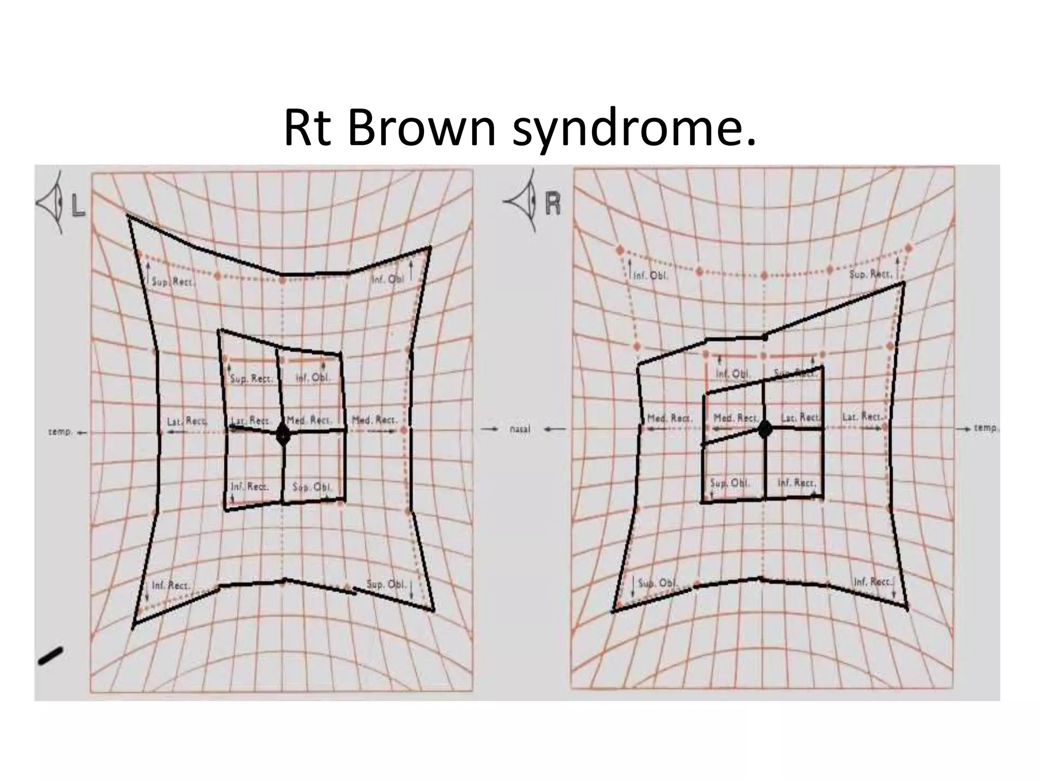Rt Brown syndrome.
 