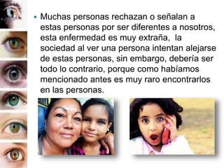 Muchas personas rechazan o señalan a
estas personas por ser diferentes a nosotros,
esta enfermedad es muy extraña, la
sociedad al ver una persona intentan alejarse
de estas personas, sin embargo, debería ser
todo lo contrario, porque como habíamos
mencionado antes es muy raro encontrarlos
en las personas.
 