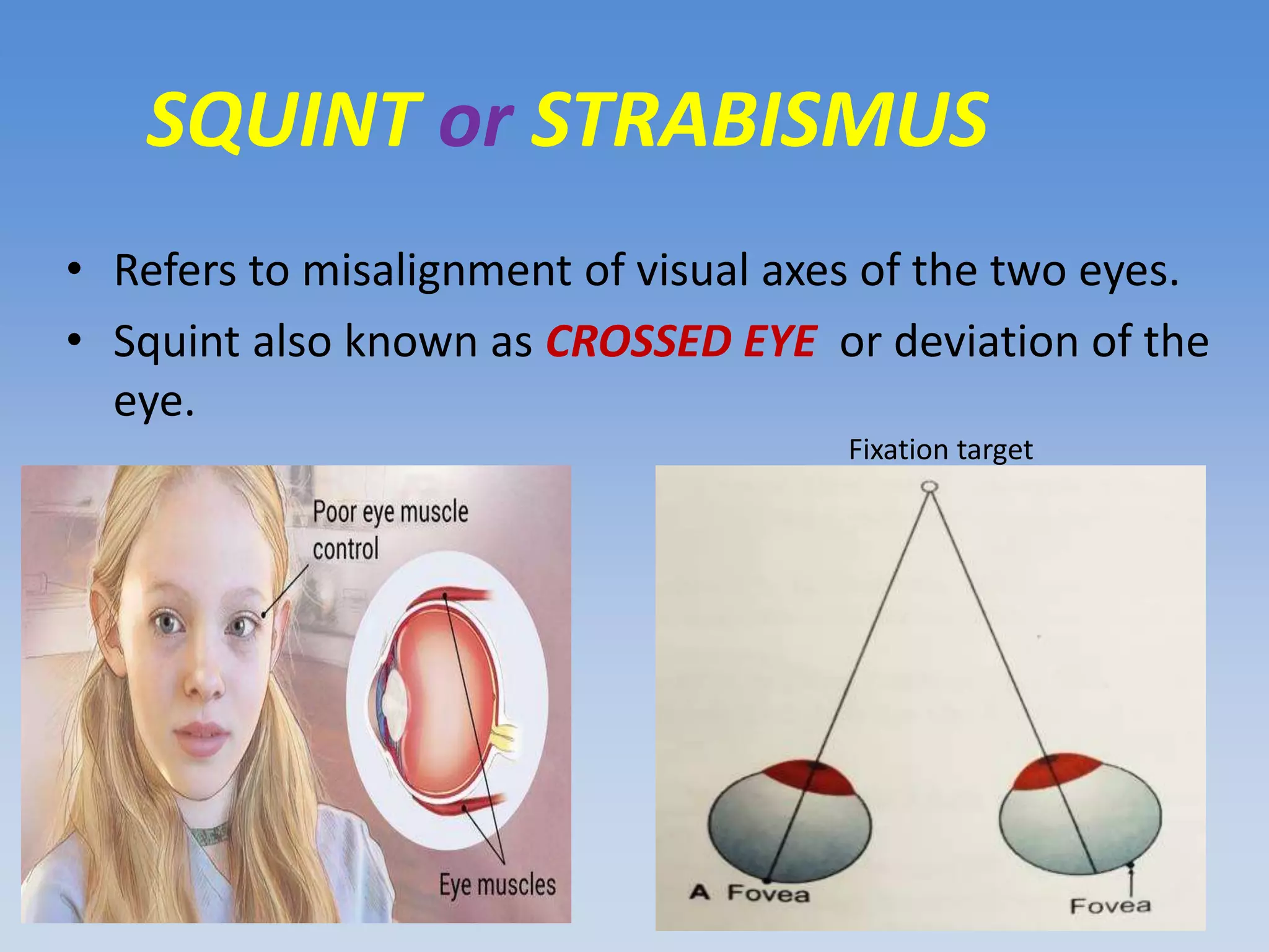 Visual Squint Heterophoria Or Latent Squint | PPTX