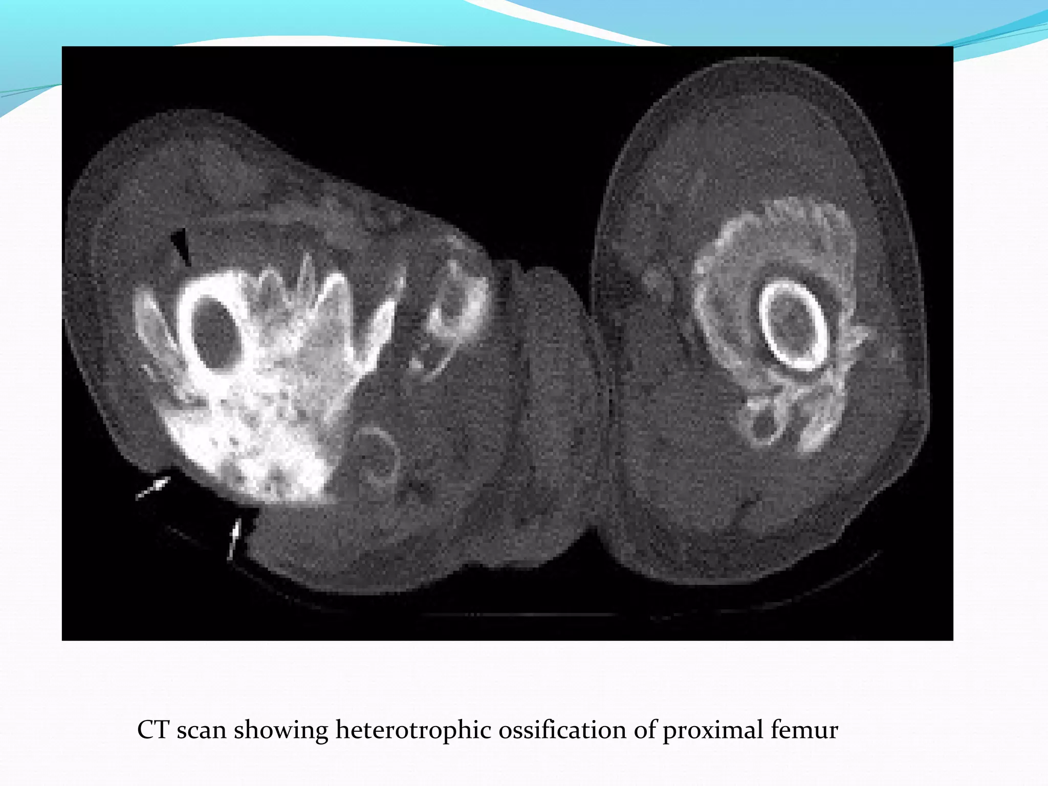 CT scan showing heterotrophic ossification of proximal femur
 