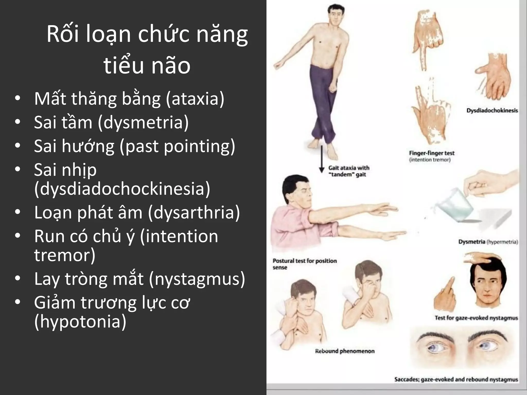 Rối loạn chức năng
tiểu não
• Mất thăng bằng (ataxia)
• Sai tầm (dysmetria)
• Sai hướng (past pointing)
• Sai nhịp
(dysdiadochockinesia)
• Loạn phát âm (dysarthria)
• Run có chủ ý (intention
tremor)
• Lay tròng mắt (nystagmus)
• Giảm trương lực cơ
(hypotonia)
 