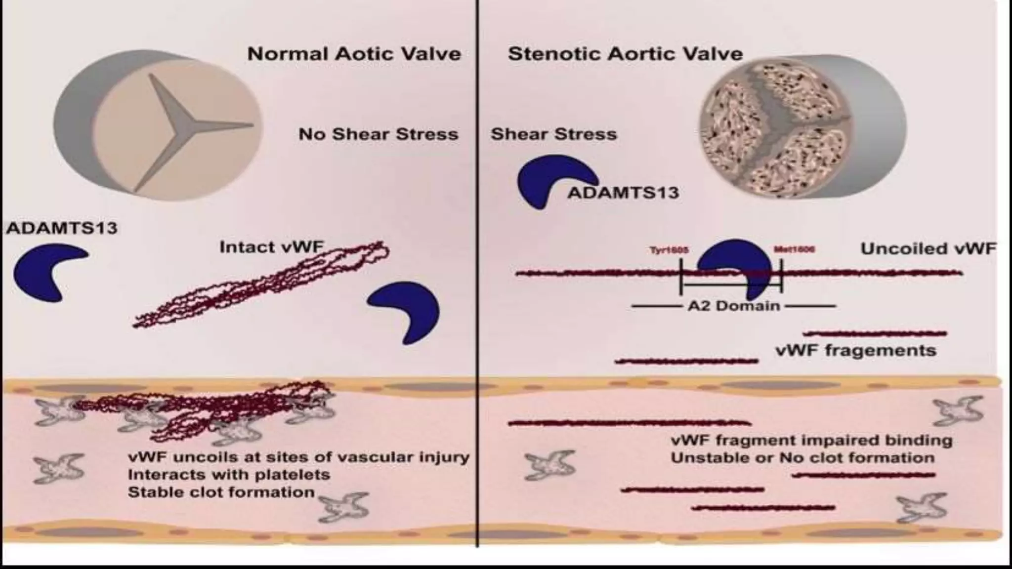 Heyde syndrome | PPTX