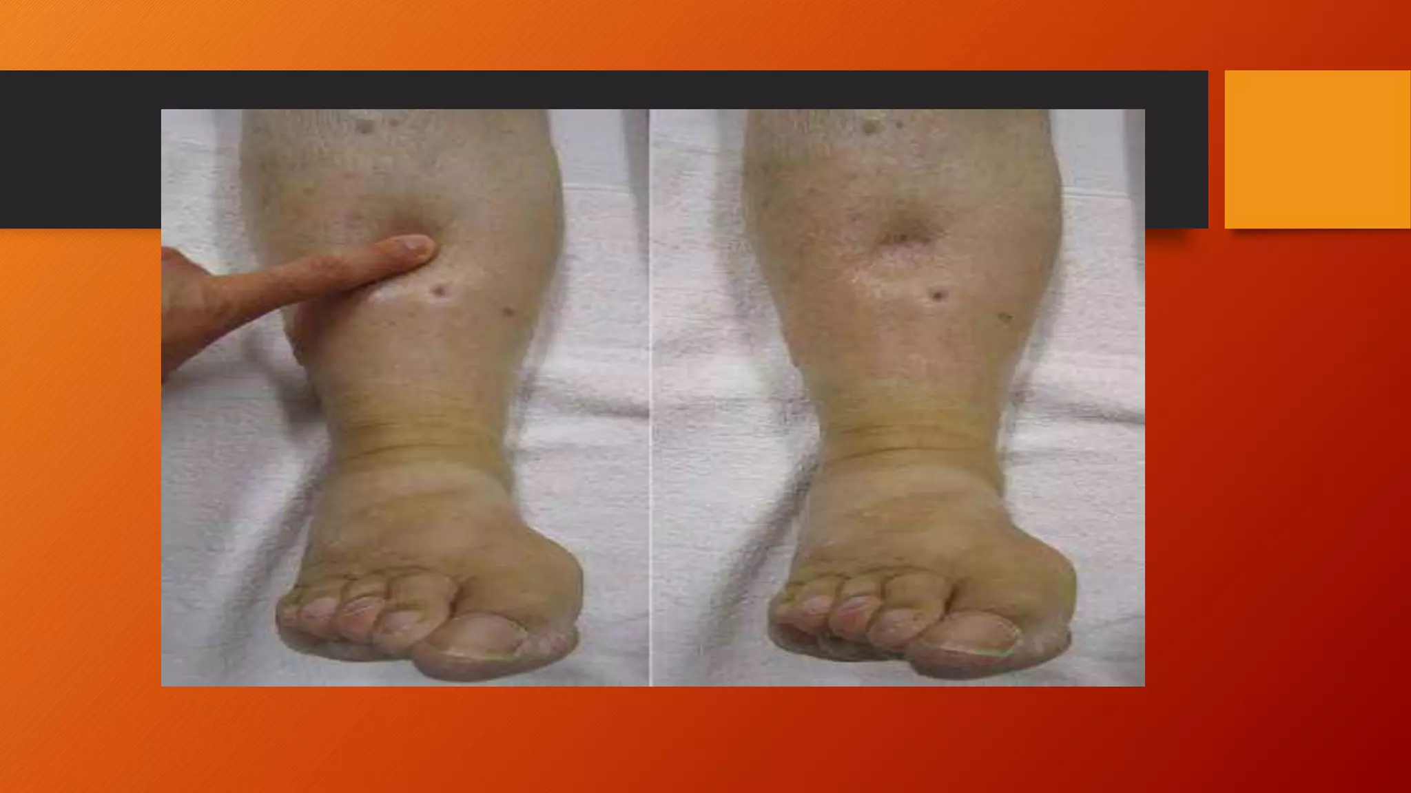 Congestive heart failure CHF | PPT